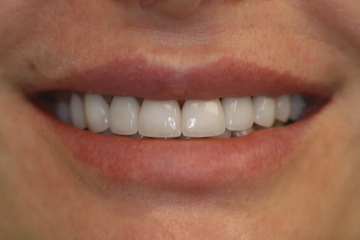 Anterior Crowns — after treatment