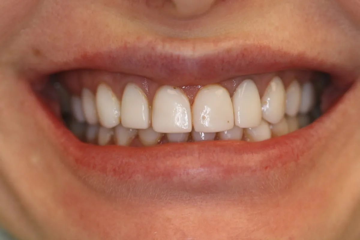 Anterior Crowns — before treatment