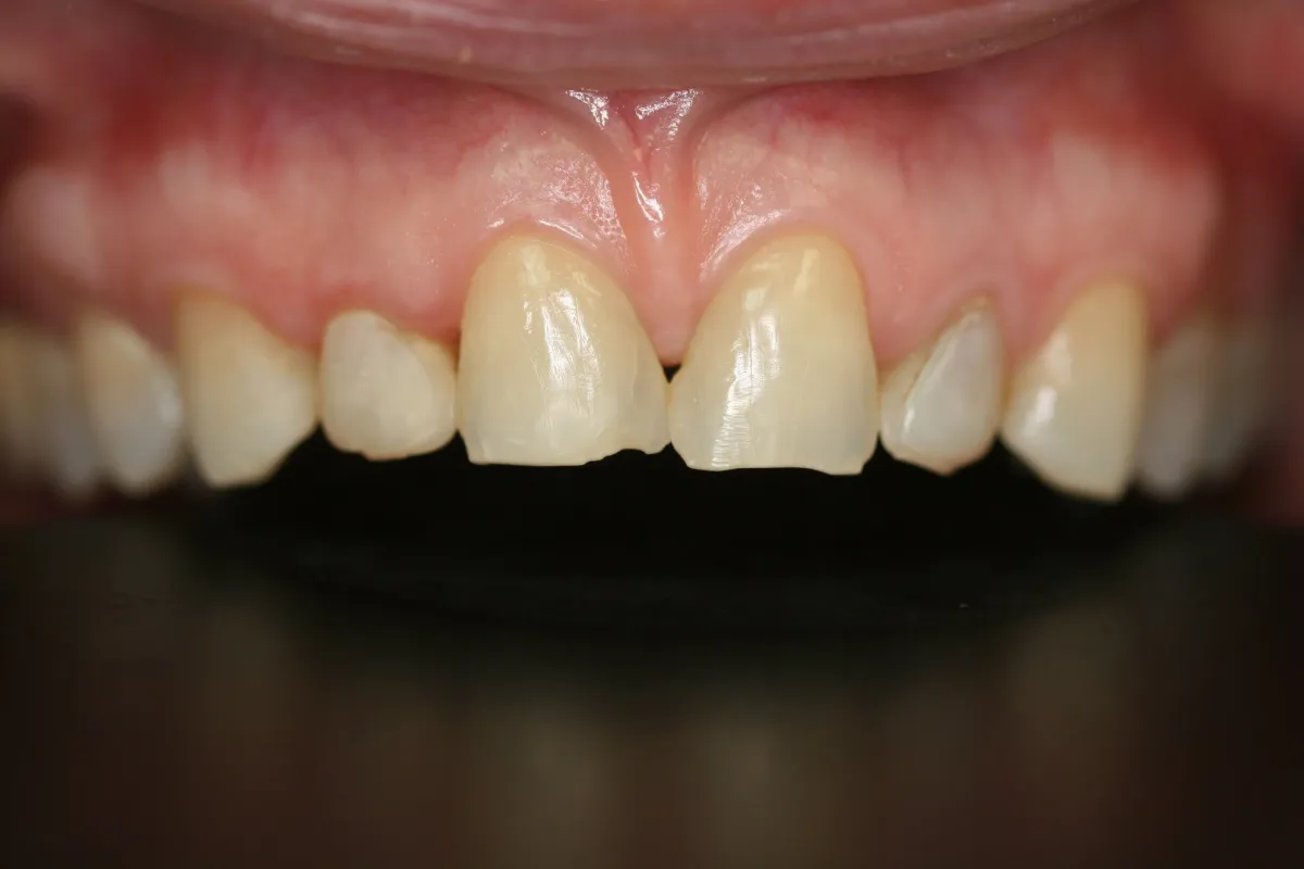 Anterior Veneers — before treatment