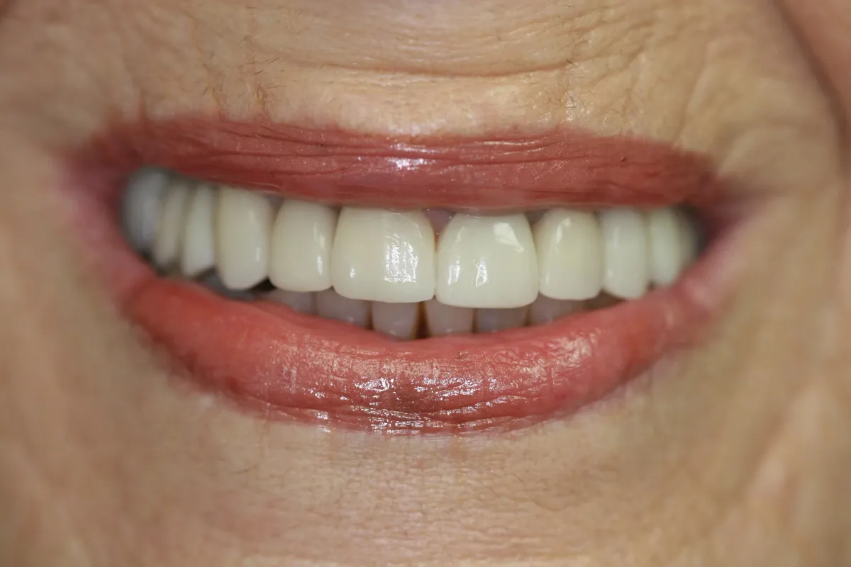 Full Mouth Reconstruction — after treatment