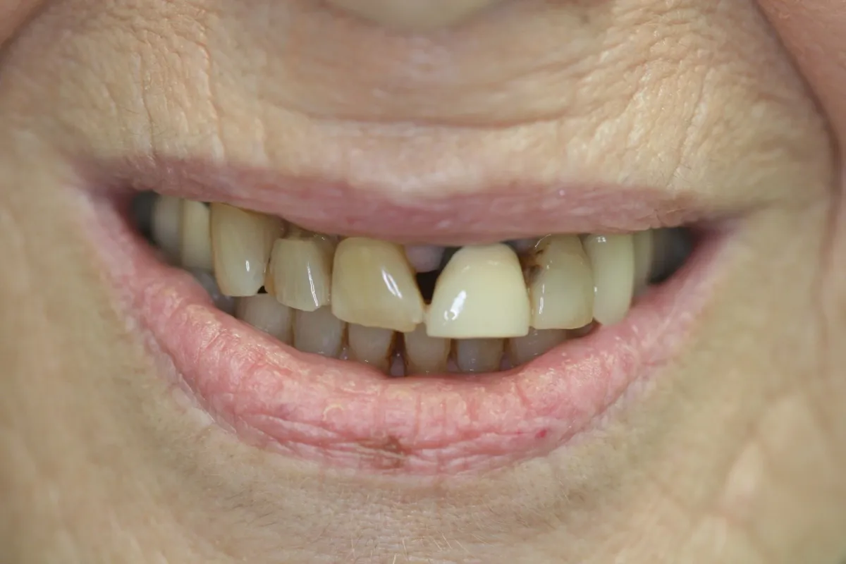 Full Mouth Reconstruction — before treatment