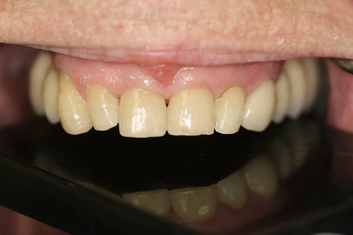 Implant Crown — after treatment