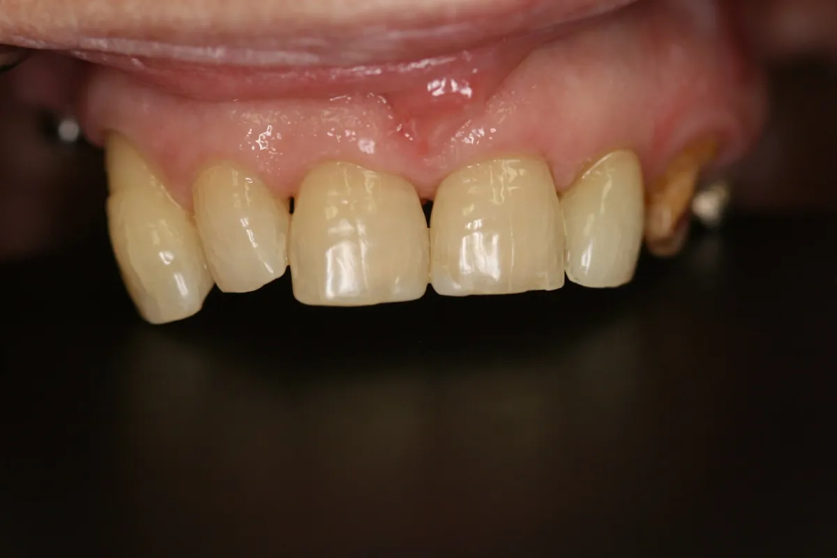 Implant Crown — before treatment